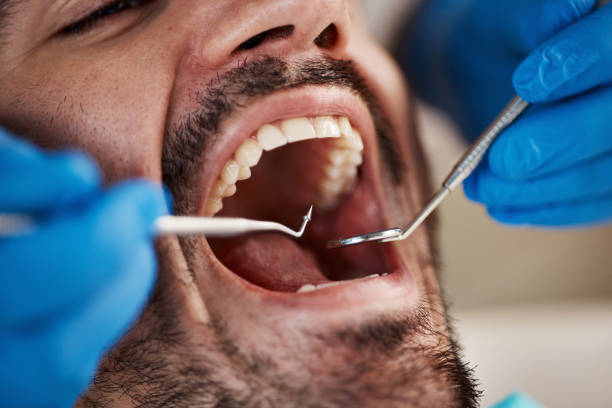 Best Emergency Wisdom Teeth Removal in Woodcrest, CA